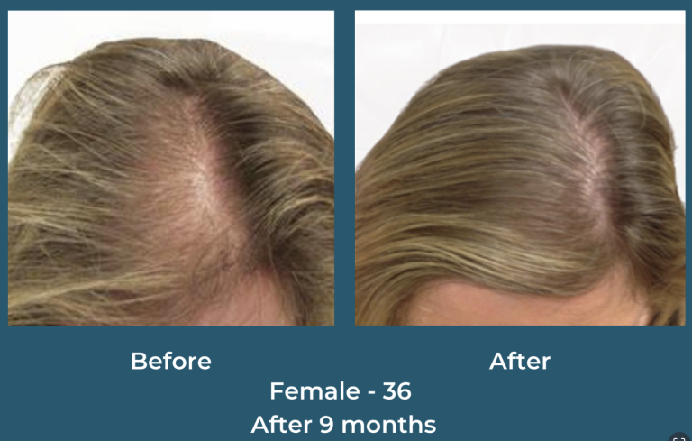 Postpartum Hair Loss: Why It Happens  –  And How LUX ~ A Medical Spa Can Help